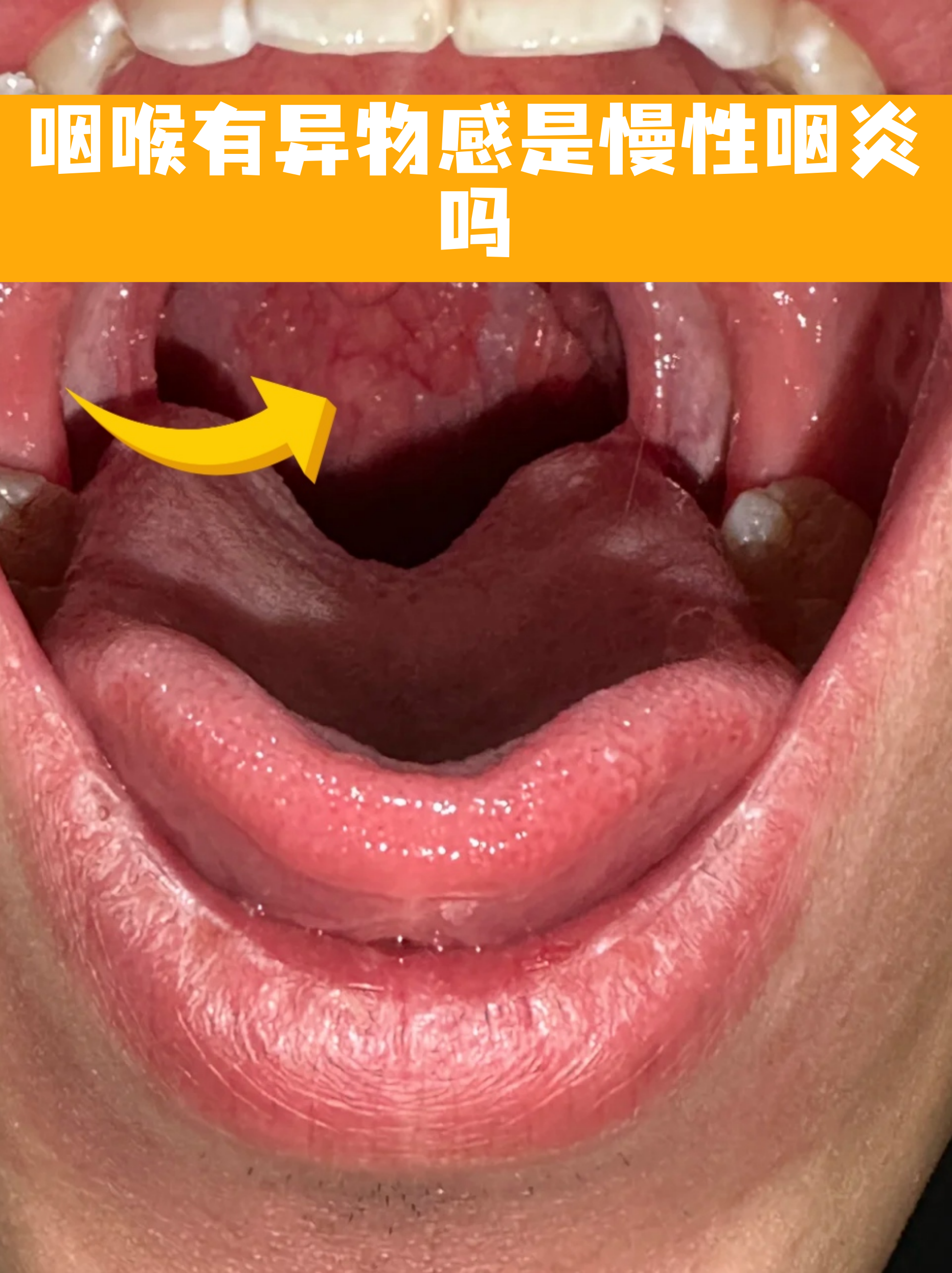 扁桃体发炎可以喝咖啡吗(扁桃体发炎吃什么药最快最有效)