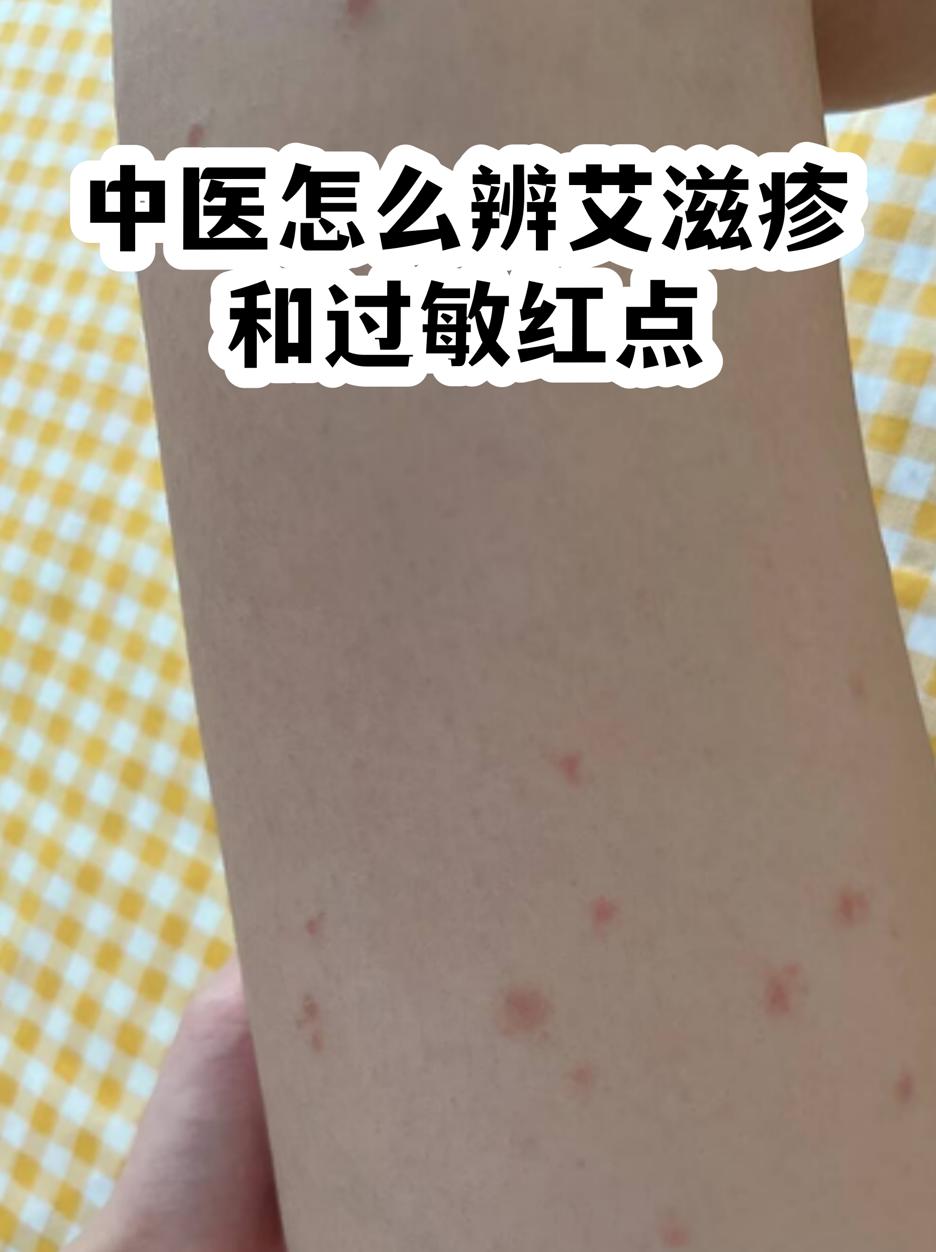 乙脑疫苗出现红疹图(乙脑疫苗出现红疹图片)