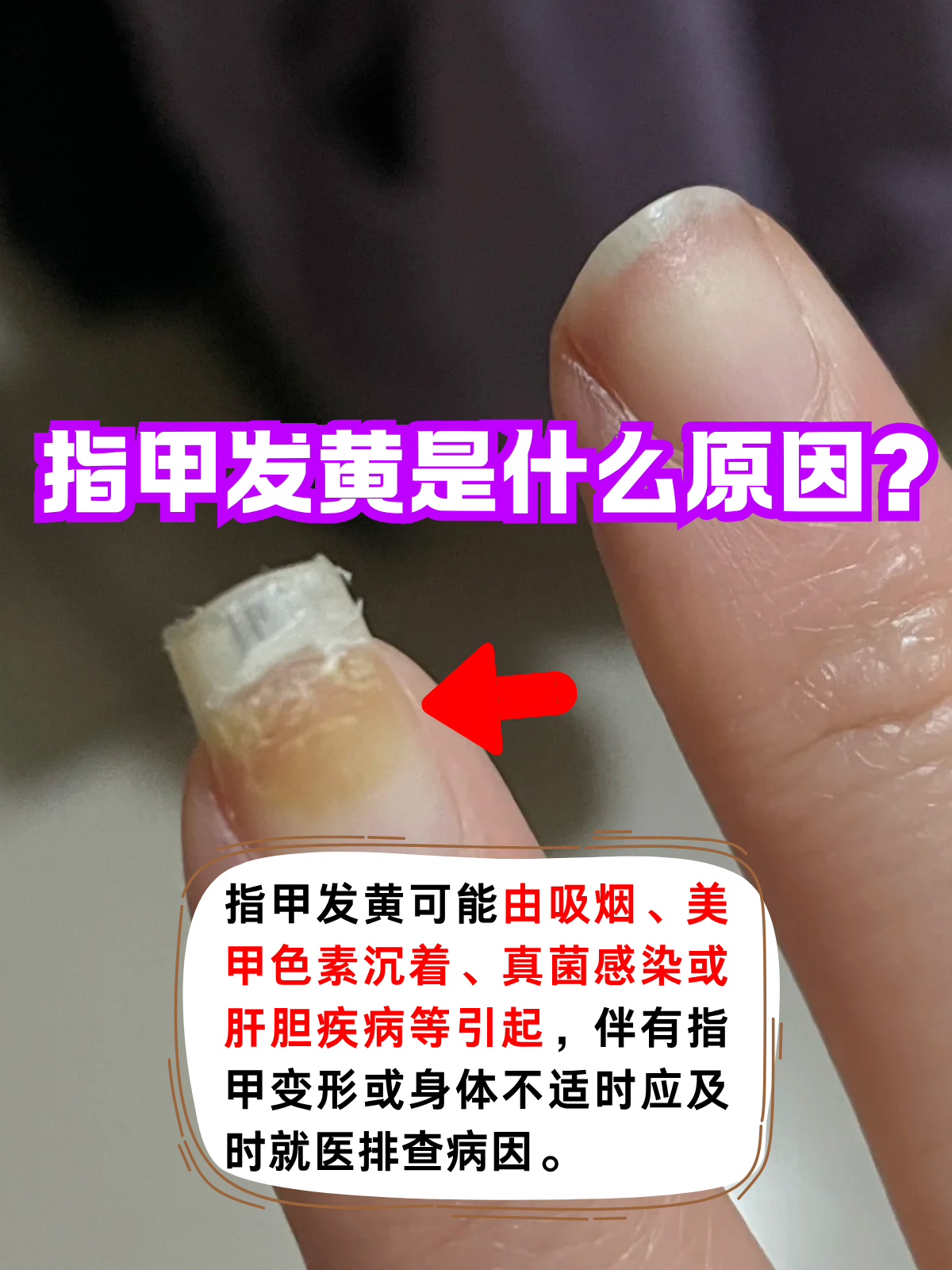 吃枇杷手指甲变黄怎么办(枇杷吃完手上的颜色怎么处理)