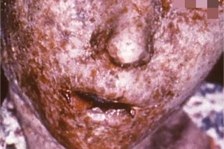 古代的天花是现代的什么病(古代天花相当于现代的什么病)