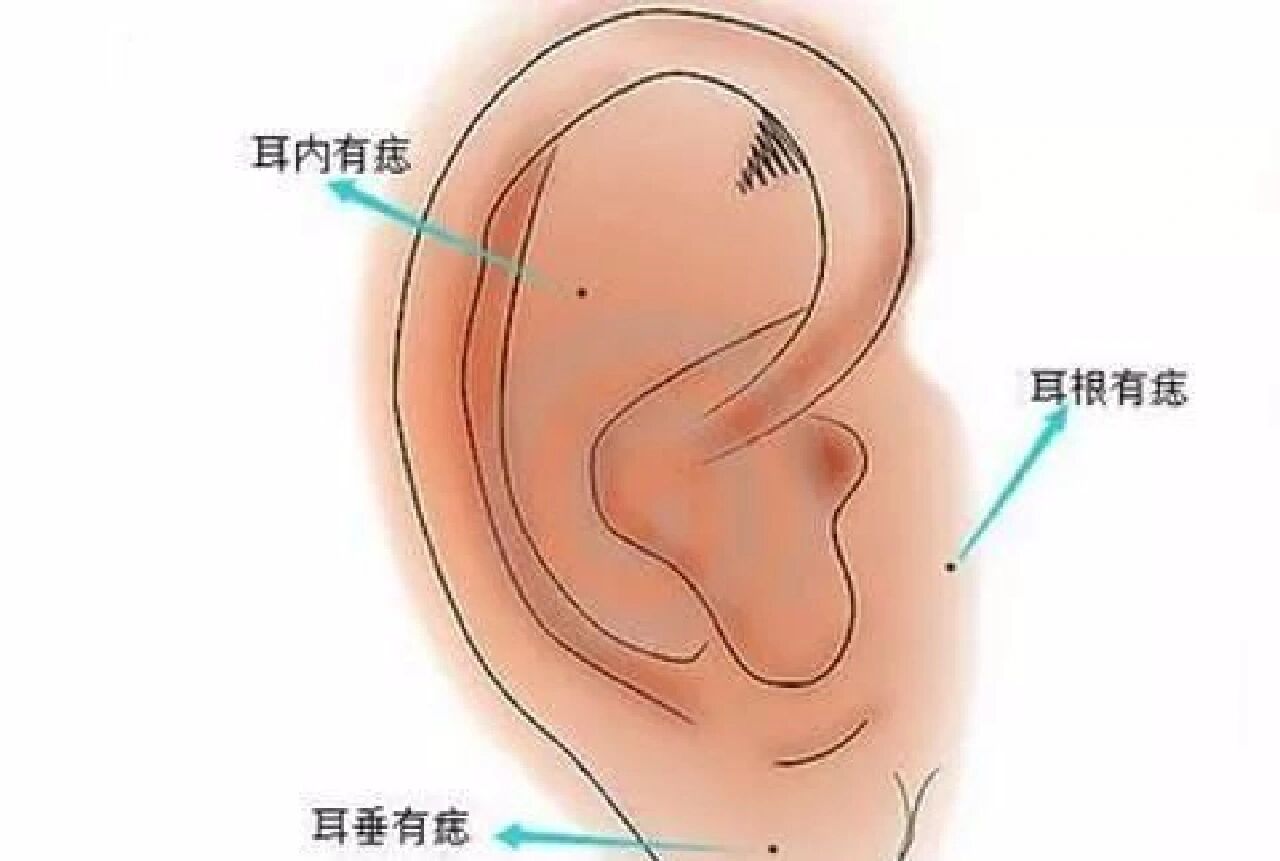 耳朵里长痣女人代表什么(耳朵里长痣代表什么意思面相学)